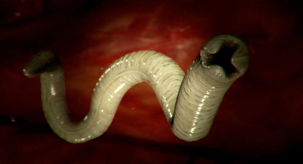 Wurm aus dem menschlichen Körper
